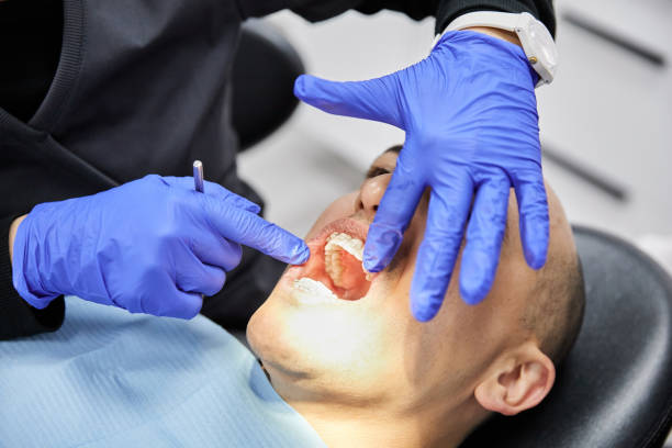 Best Emergency Wisdom Tooth Extraction in USA